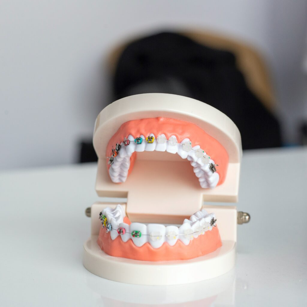 יישור שיניים בשיטה רגילה